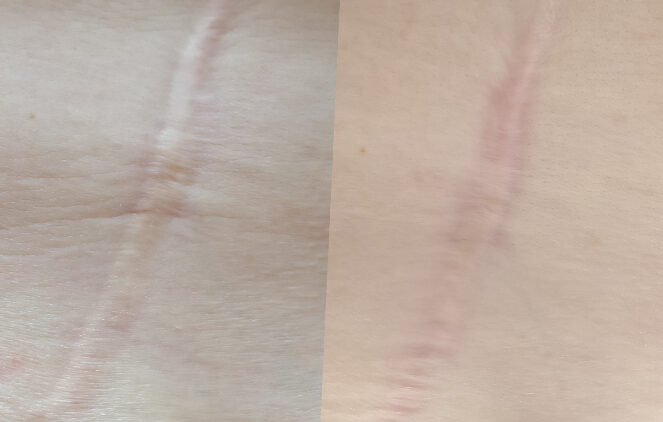 Scar-Before-After-GallBladder-01